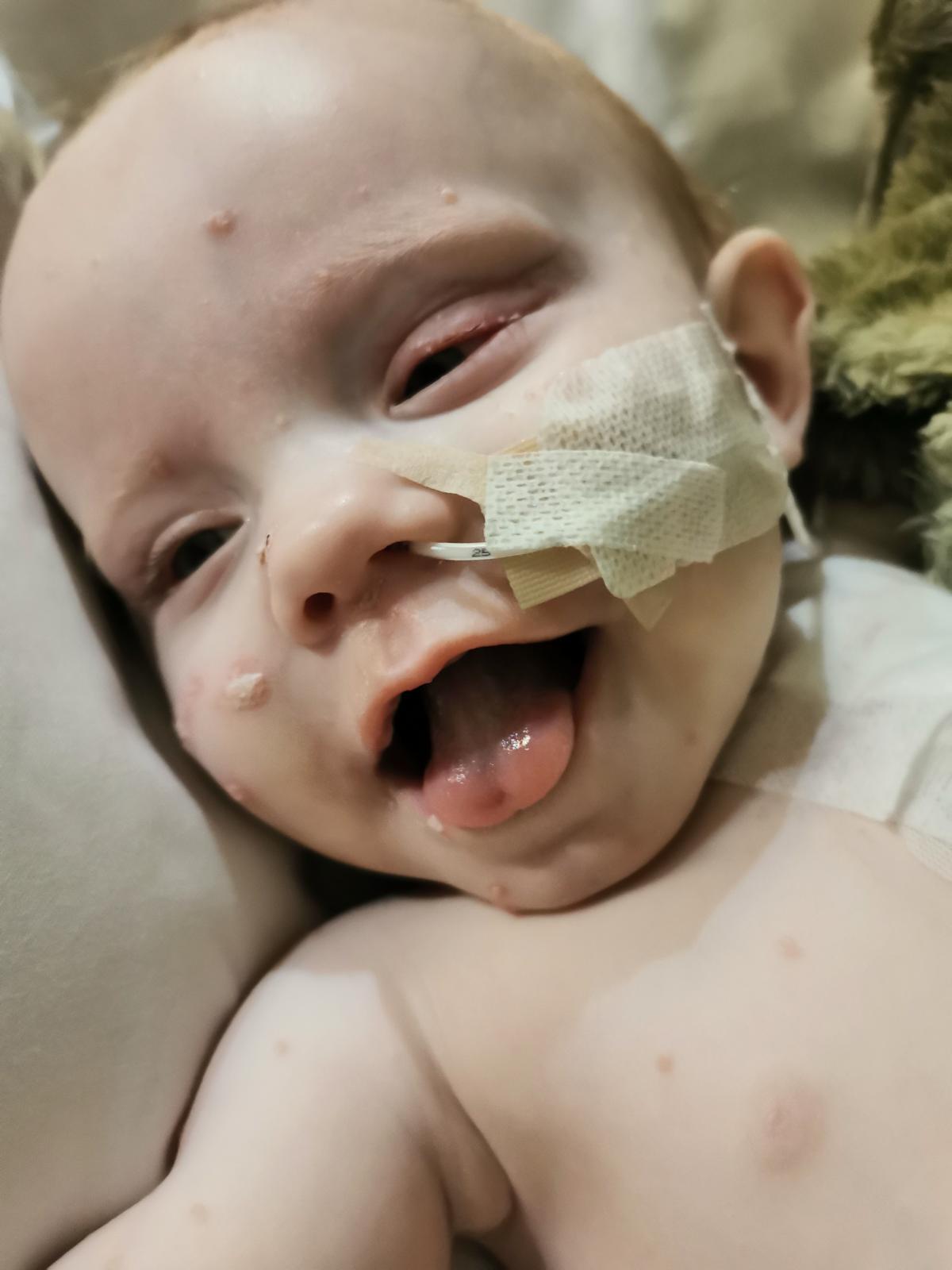 Baby Seth lacht met zijn maagsonde in zijn neusje